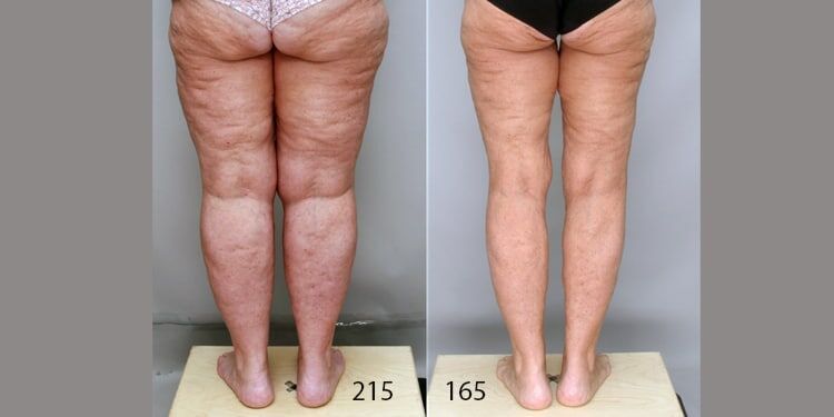 will insurance cover glp 1 for lipedema Your Complete Guide to Lipedema Surgery in 2026